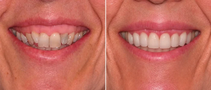 antes despues carillas dentales caso 3