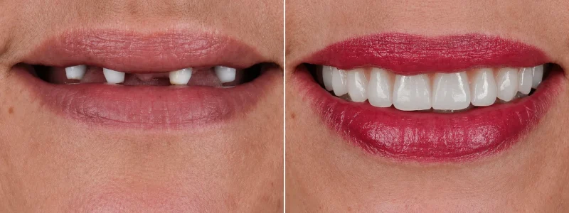 antes despues implantes dentales caso 2