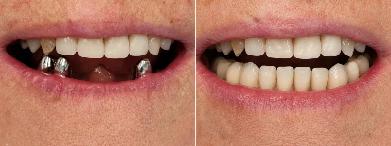 antes despues implantes dentales caso 3